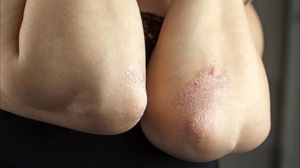 Причины и лечение сухой кожи на локтях в домашних условиях