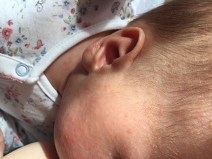 Сыпь на лице у новорожденного: лечение