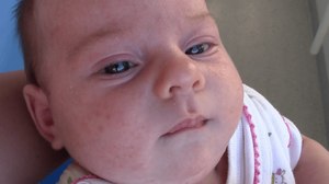 Сыпь на лице у новорожденного: диагностика
