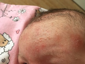 Сыпь на лице у новорожденного: причины