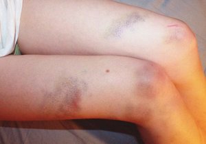 Причины синяком на ногах