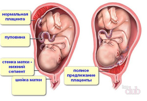 znachit nizkaya placentaciya