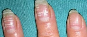 Белые пятна на ногтях пальцев рук  