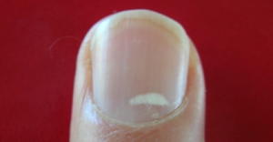 Белые полоски на ногтях  