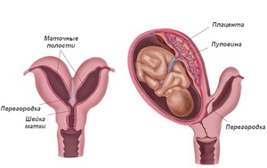 Двурогая матка: осложнения беременности
