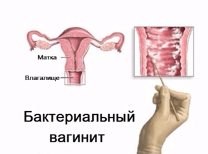 Как протекает заболевание вагиноз