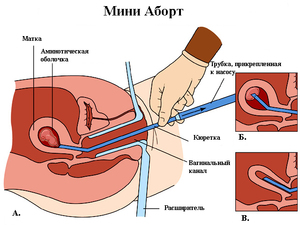 Как выполняется мини аборт ваккумом