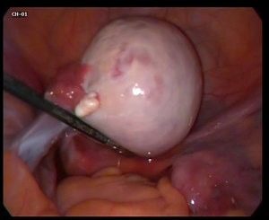 Киста яичника – полый отросток на поверхности или в теле органа, заполненный слизью