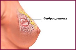 Послеоперационный период фиброаденома молочной железы