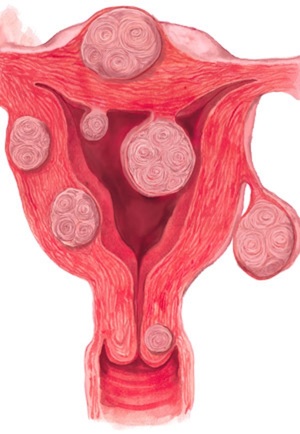 Узловатая миома матки с геморрагическим синдромом