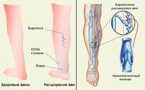 Лечение  варикозного расширения вен на ногах