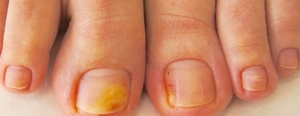 Особенности лечения грибка ногтей