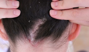 Грибок кожи головы: причины и лечение