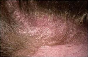 Причины грибка кожи головы