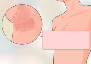 Причины раздражения опрелости  груди