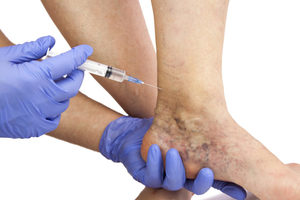 Медикаментозное лечение варикоза на ногах