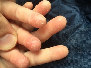 Причины и лечение трещин пальцев на руках 