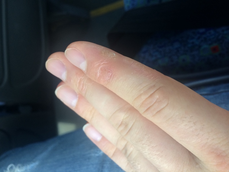 Что делать если трескается кожа на пальцах рук