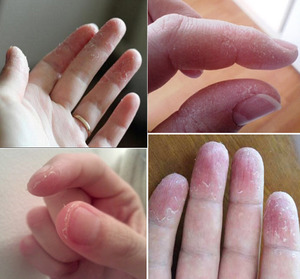 Причины и лечение трещин на пальцах рук 
