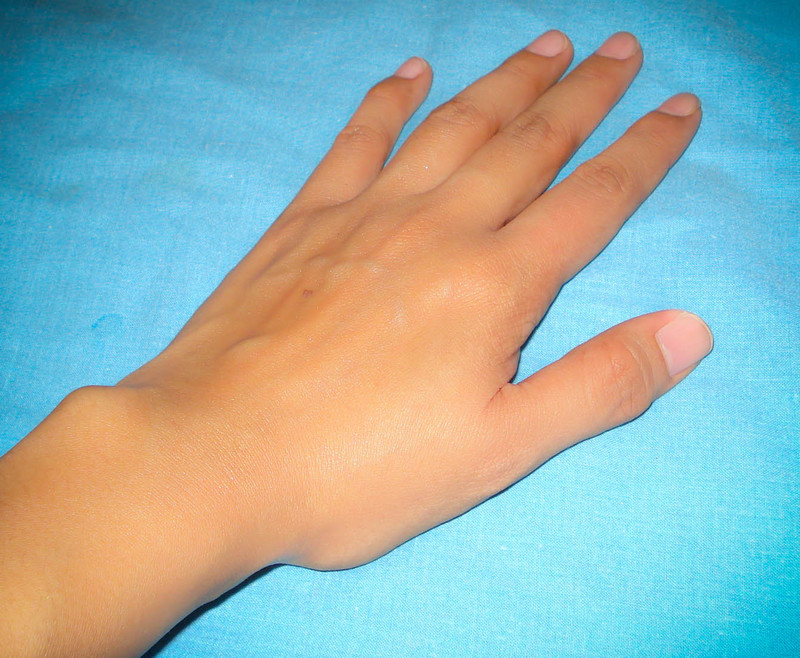 От чего трескается кожа на пальцах рук