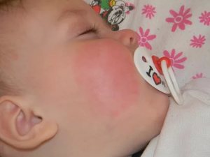 Причины красных щек у ребенка по комаровскому