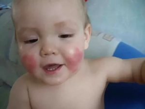 Причины красных щёк у ребёнка по доктору Комаровскому