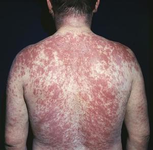 Виды аллергии на коже