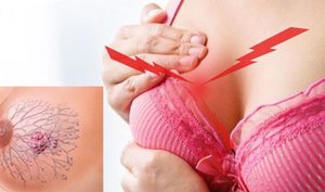 Симптомы и причины фиброзно-кистозной мастопатии