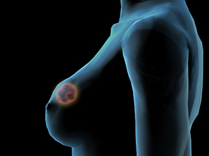 Как лечат рак молочной железы