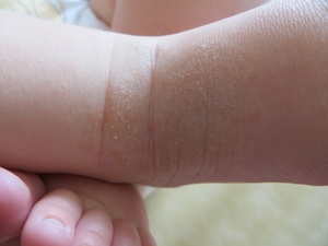 Причины сухой кожи у малыша