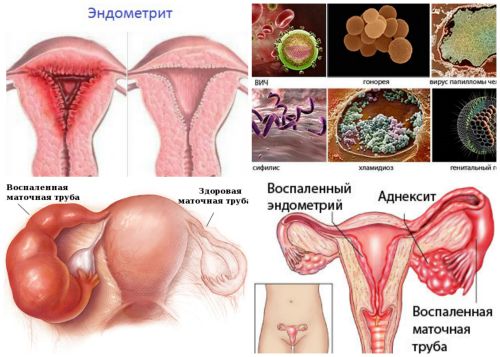 Воспаление внутренней оболочки матки. Послеродовой эндометрит. Воспаление эндометрия. Хронический эндомиометрит.