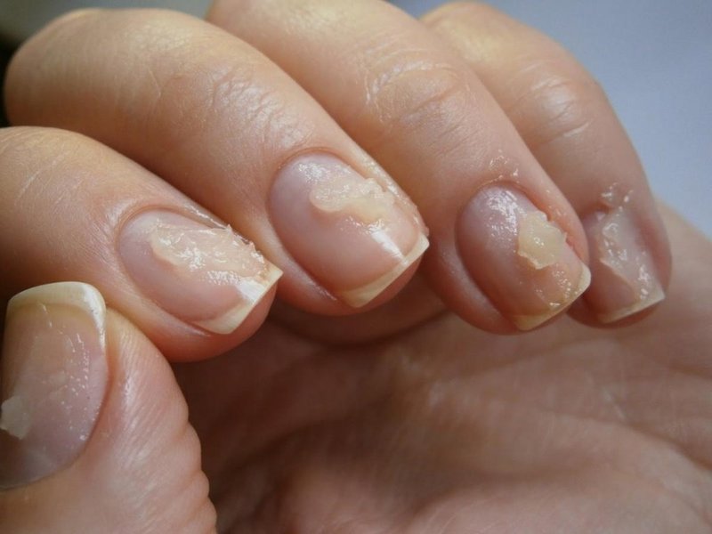 Чем лечить ногти после наращивания
