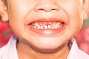 Молочные зубы у детей 
