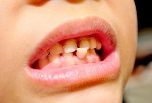 Симптомы прорезания зубов