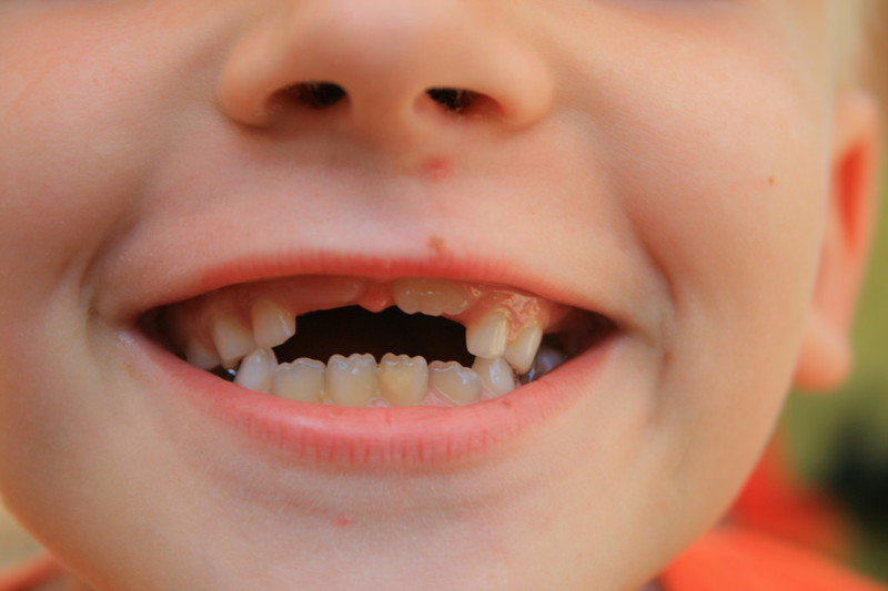  Задержка выпадения зубов у ребенка