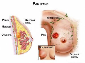 Болезни молочных желез у женщин