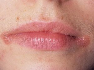 Причины и лечение заедов в уголках рта