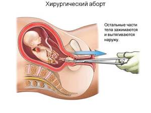 Хирургический аборт