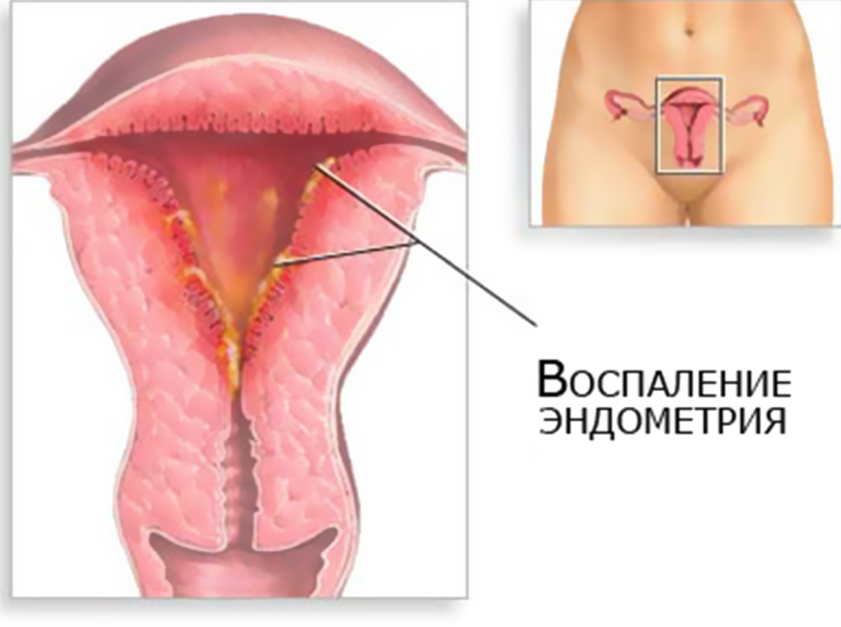 Эндометрии в полости. Воспаления внутренней оболочки матки. Послеродовой эндометрит. Герпетический эндометрит. Эндометрит это воспаление.