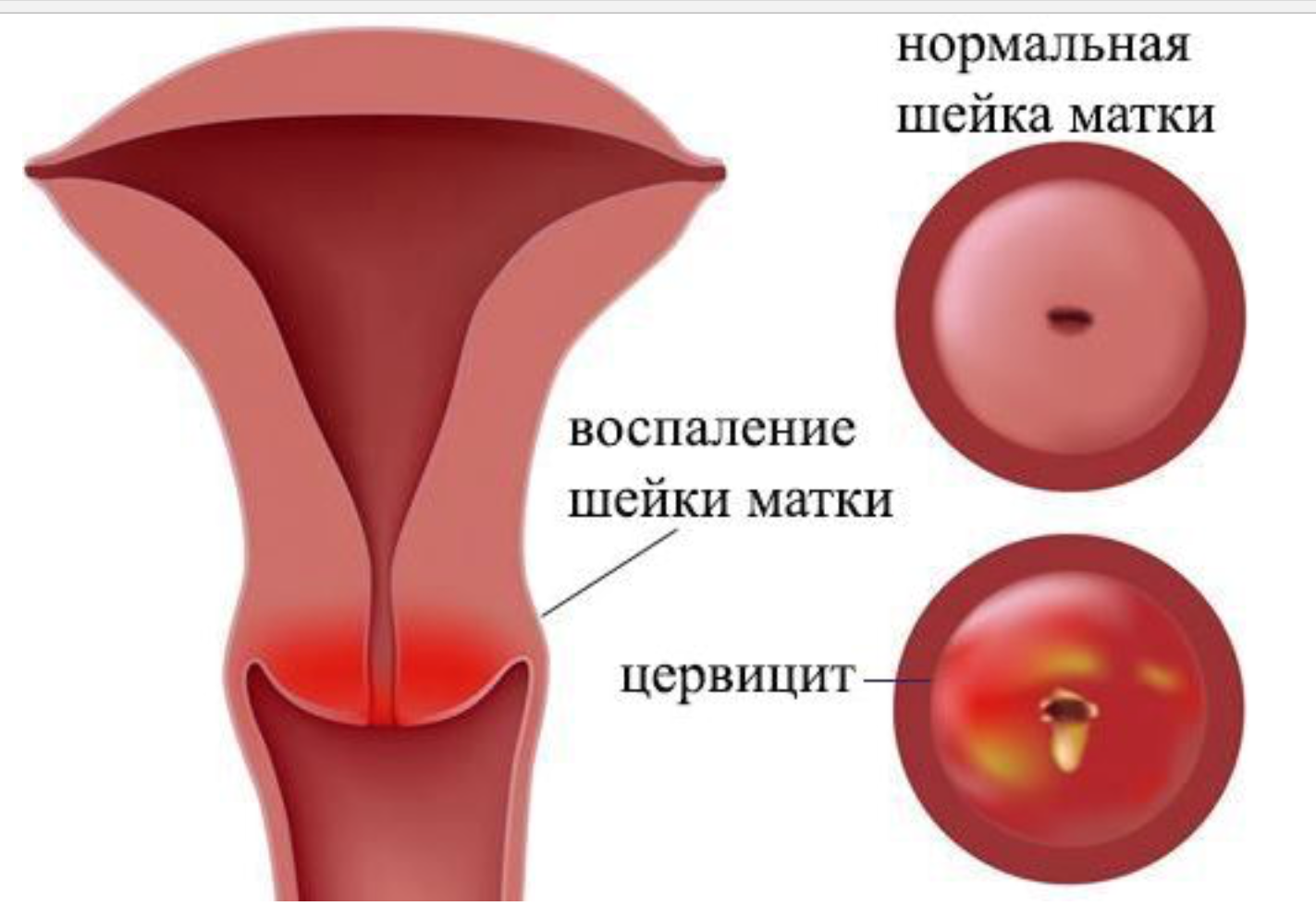 Лечение цервикального канала у женщин