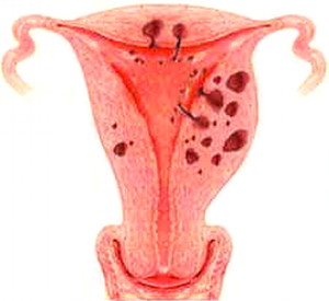 Утолщение эндометрия матки причины