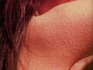Что делать с гусиной кожей на теле. Гусиная кожа на руках, ногах и попе: болезнь или мелкая неприятность