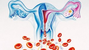 Обильные менструации (меноррагия)