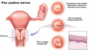 Беременность после терапии эрозии