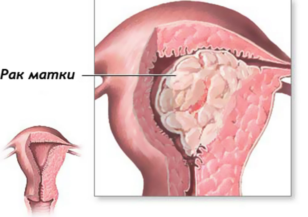 Новообразование эндометрия. Злокачественное новообразование шейки матки. Злокачественное новообразование эндометрия.