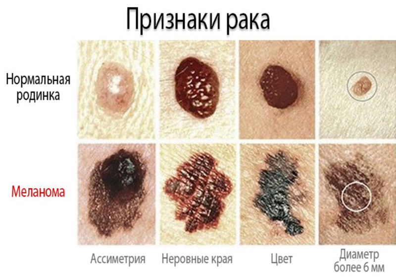 Определяем тип рака кожи