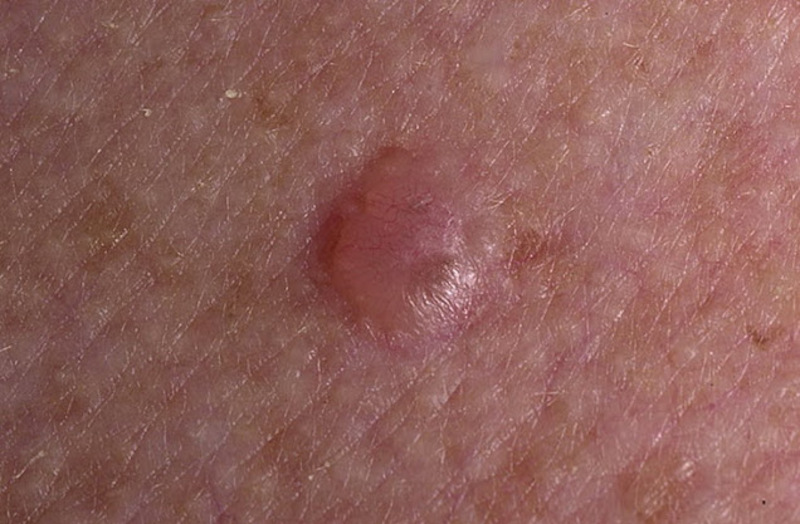 Онкологические заболевания кожи
