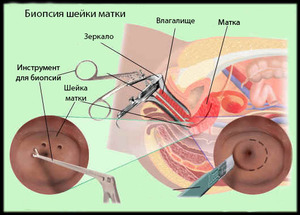 Биопсия шейки матки инструменты