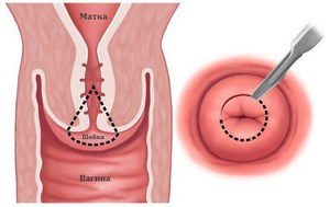Анализ биопсия шейки матки: показания к назначению и подготовка к процедуре