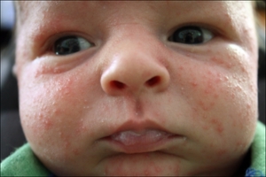 На что у новорожденного может быть аллергия в виде прыщиков на лице thumbnail